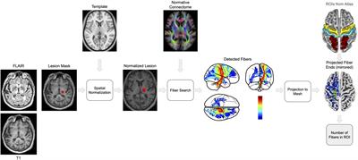 Normative connectome-based analysis of sensorimotor deficits in acute subcortical stroke